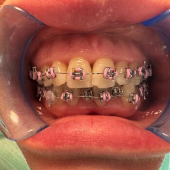 Aparatul dentar la maturitate: sănătate, nu doar estetică