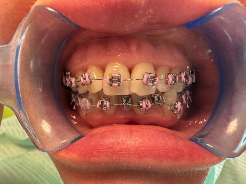 aparat dentar Aparatul dentar la maturitate: sănătate, nu doar estetică
